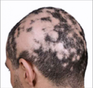 alopecia-areata-500x500.png
