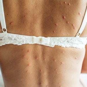 Fly-bites-on-a-womans-back.jpg